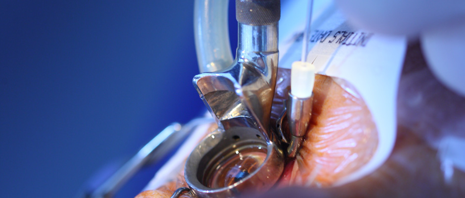 In addition to LASIK, epi-LASIK and PRK, Dr. Lewis uses his excimer lasers to treat pathology. Here, a patient with severe anterior corneal dystrophy is having photo-therapeutic keratectomy. The Amoils Brush (Innovamed) and Mastel Laser Clean Room (Mastel Precision) are staples of his operating suite.